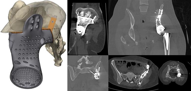 MT Ortho - oncological custom made device.
(Foto: GE Additive, GEADPR039)