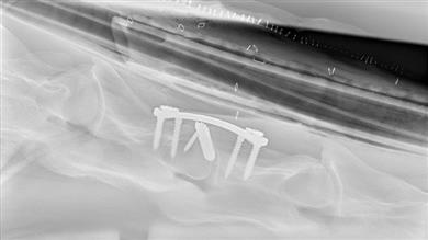 Single level spine stabilization by 3D Medical’s custom-made cage and plate and customised insertion tool. 
(Photo: Clinique de Grosbois, GEADPR058)