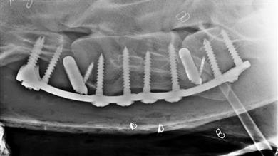 Double level spine stabilization by 3D Medical’s custom-made cages and plate and customised insertion tool. 
(Photo: Clinique de Grosbois, GEADPR058)